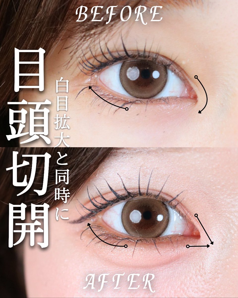 dr_maruyama's tweet photo. 【目頭切開で垢抜け？！】
目頭切開リドレープ法
モニター価格198,000円 https://t.co/03R44hdhgC