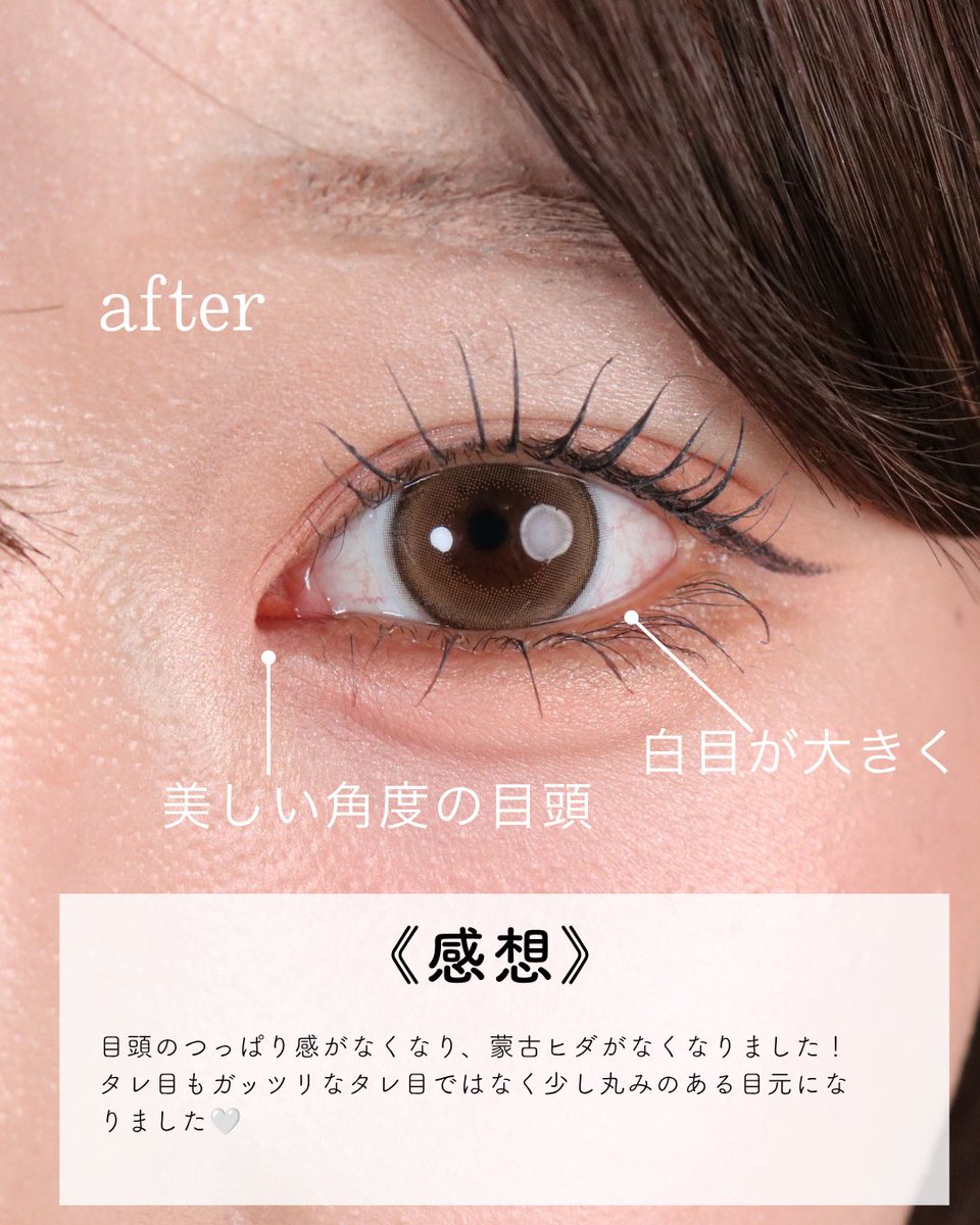 dr_maruyama's tweet photo. 【目頭切開で垢抜け？！】
目頭切開リドレープ法
モニター価格198,000円 https://t.co/03R44hdhgC