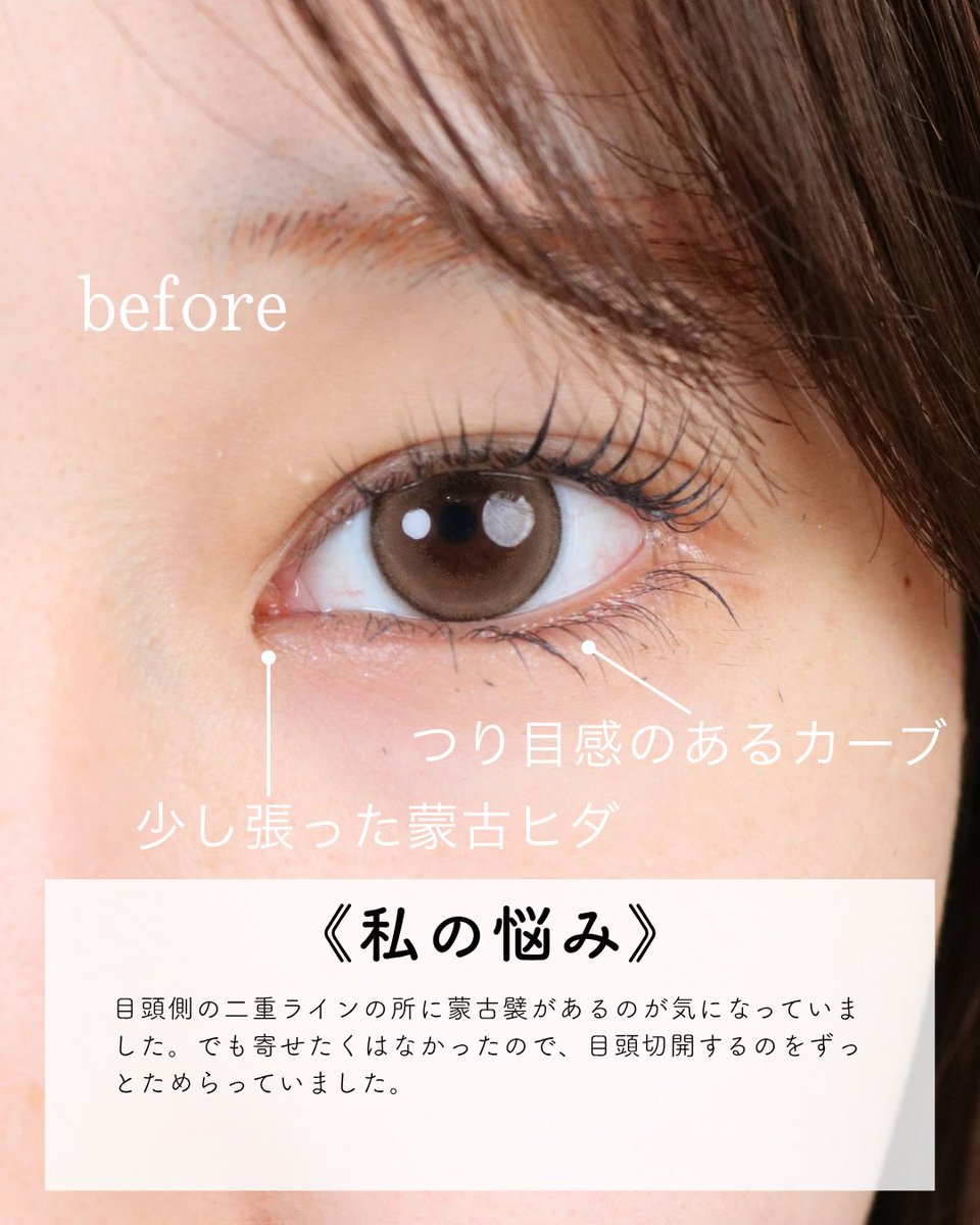dr_maruyama's tweet photo. 【目頭切開で垢抜け？！】
目頭切開リドレープ法
モニター価格198,000円 https://t.co/03R44hdhgC