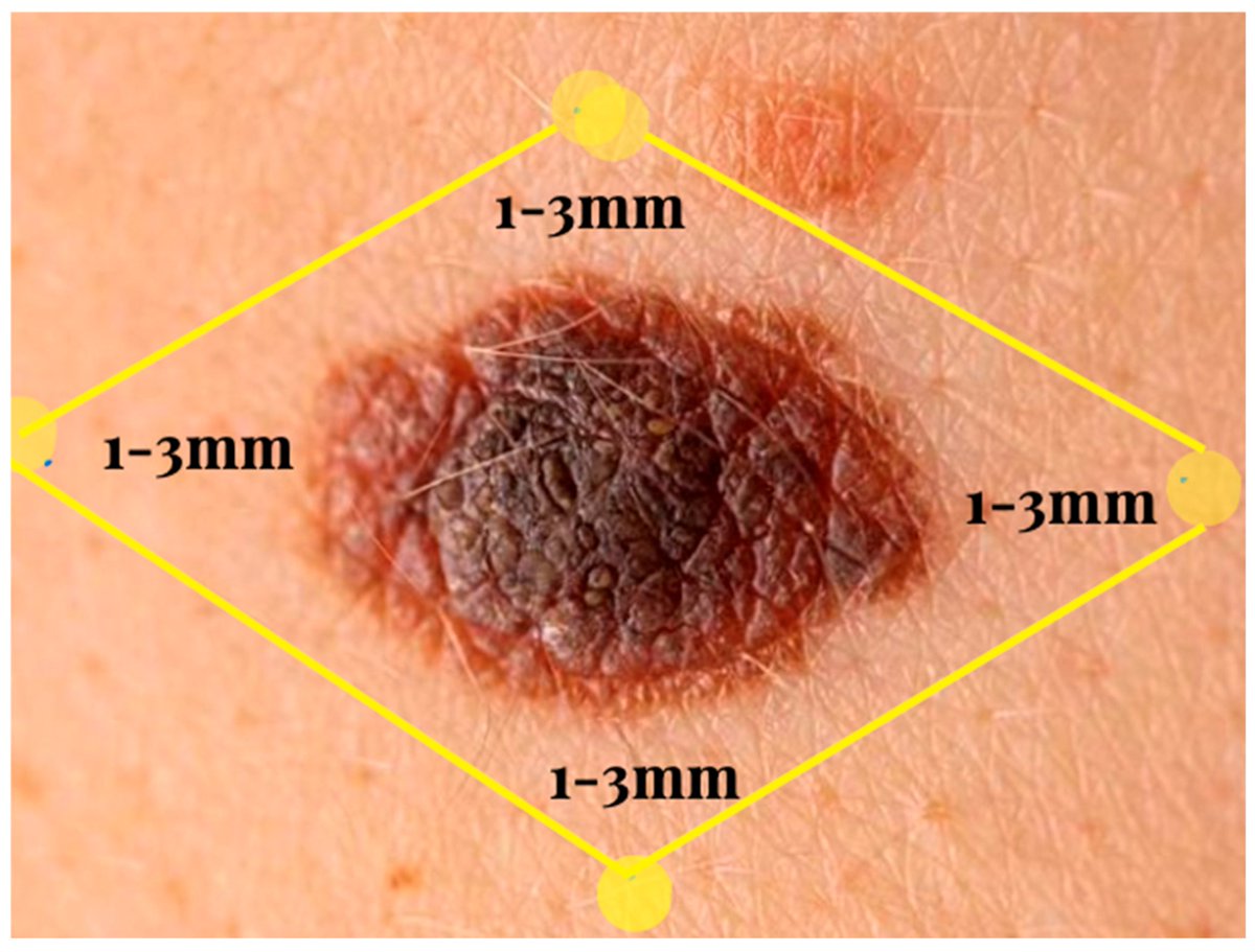 mdpi_dermato's tweet photo. 🔬🎗️ Read in #DermatoMDPI:

"Melanoma: Updates and Future Perspectives in Surgical Management"

By José Maria Zepeda Torres et al.

📖 https://t.co/bg9QzJtGv3

#Melanoma #Dermatology #SkinCancer #SurgicalOncology #Oncology #OpenAccess #MDPI https://t.co/bAjh7pXTm0