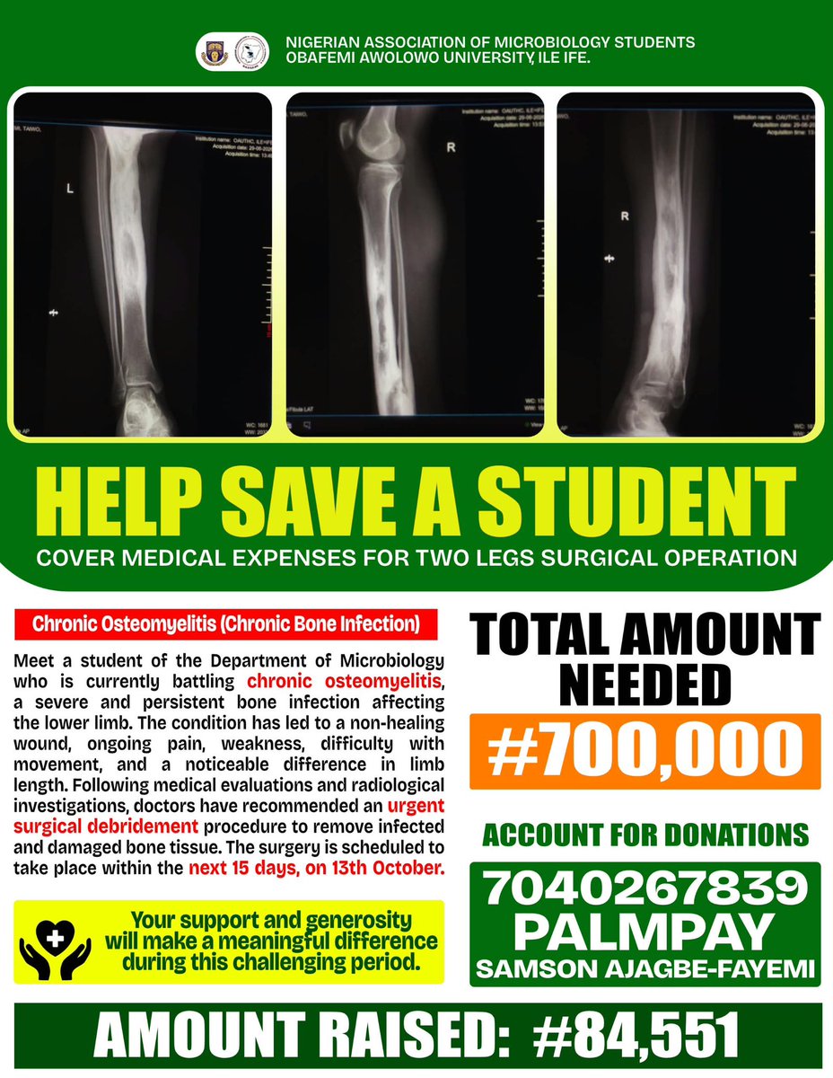 _NAMSOAU's tweet photo. Through the generosity of the public, we’ve raised ₦84,551 out of ₦700,000. ❤️🙏

We sincerely appreciate every donation and support so far. However, we still need your help to reach the target for the surgery.

Every contribution counts. 🙏❤️ https://t.co/ARt7AGYiQ8