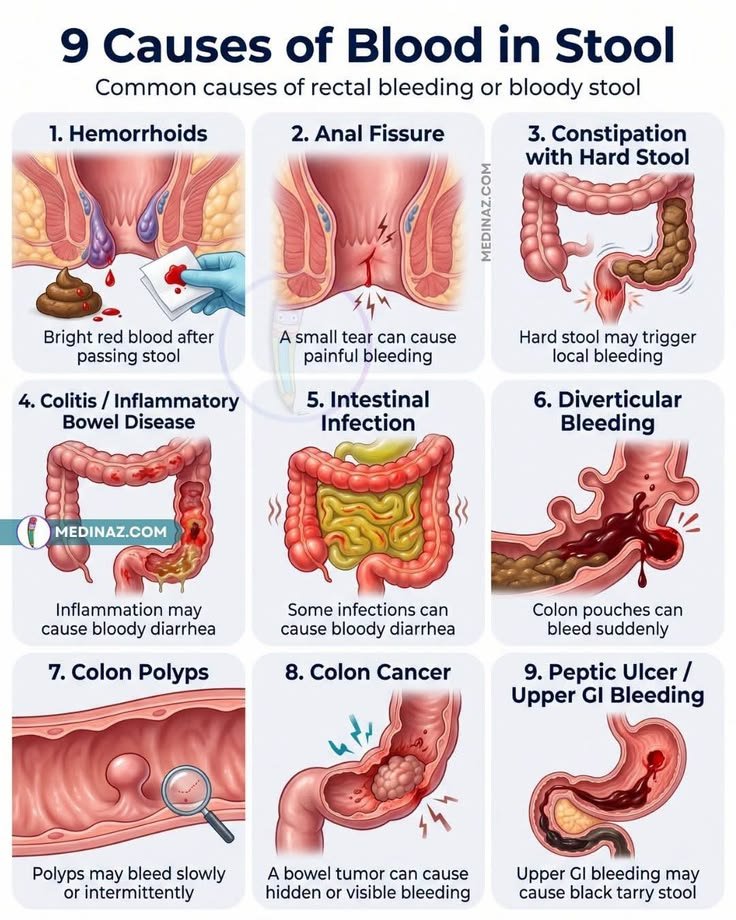 Healthylife_HQ's tweet photo. Causes of blood in stool; https://t.co/c632pKIGiP