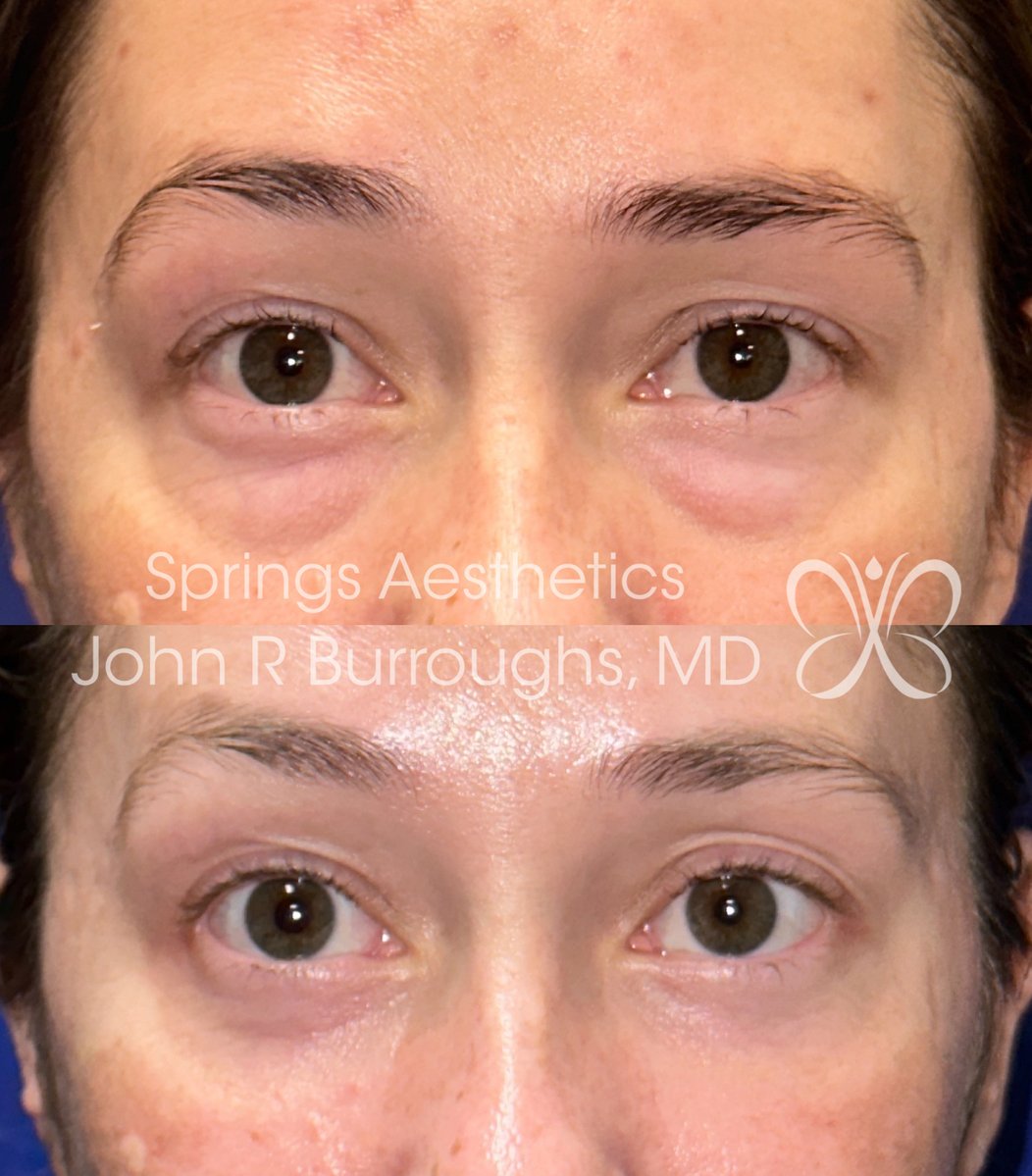 drjohnburroughs's tweet photo. Discover the secret to a refreshed, youthful appearance with lower eyelid blepharoplasty. Let your eyes shine with renewed vitality. Visit Springs Aesthetics today.
#eyerejuvenation #blepharoplasty #SpringsAesthetics #ColoradoSprings #CO https://t.co/Ol31GEbqnr