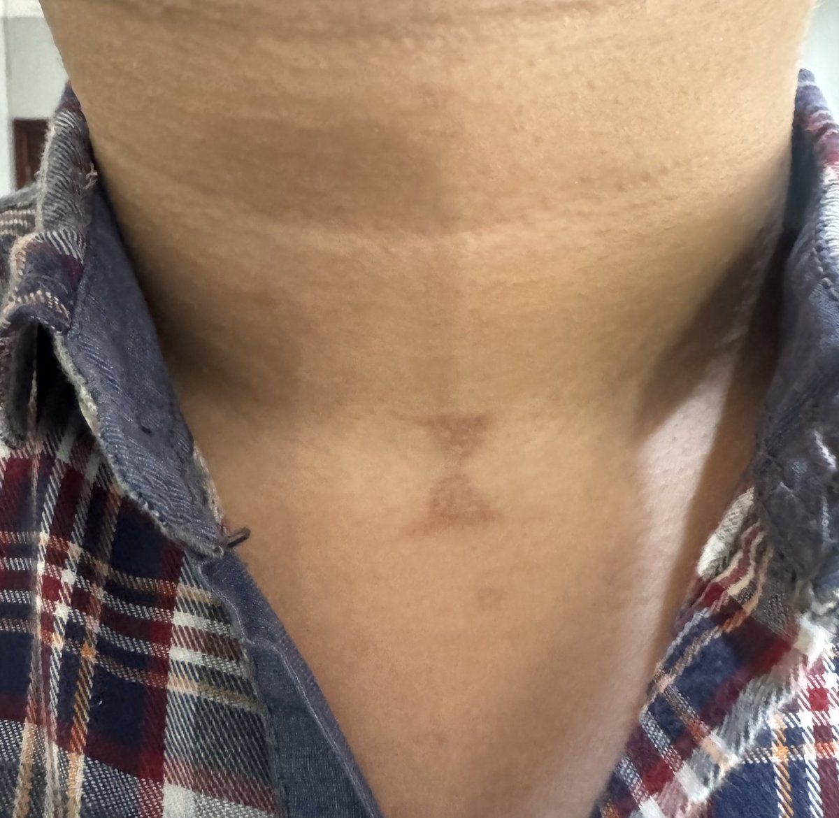 onlyabidoang's tweet photo. A rove beetle gave me a rash on my neck a few months ago and now I have a scar that looks like an hourglass https://t.co/0tvdDZVxo6