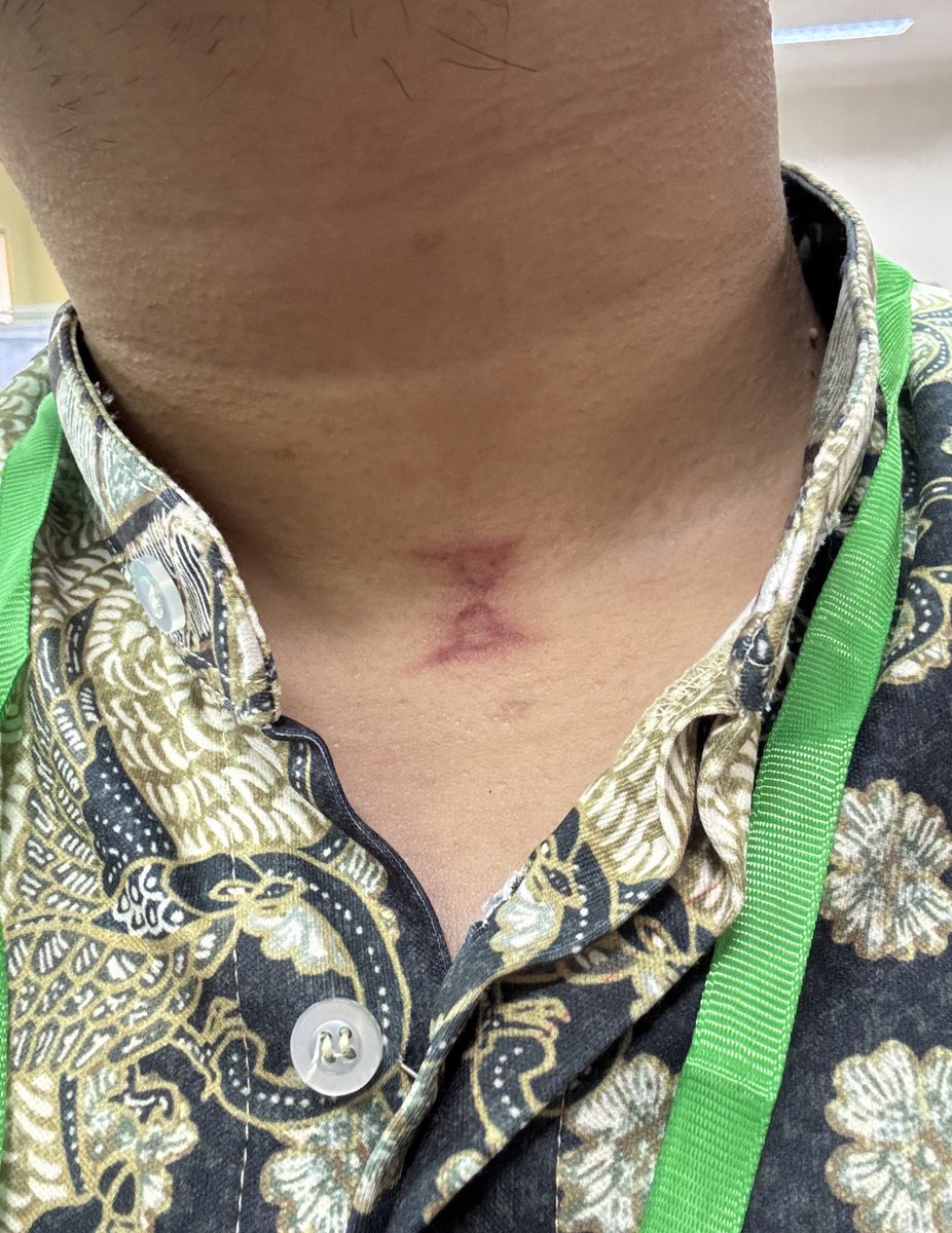 onlyabidoang's tweet photo. A rove beetle gave me a rash on my neck a few months ago and now I have a scar that looks like an hourglass https://t.co/0tvdDZVxo6