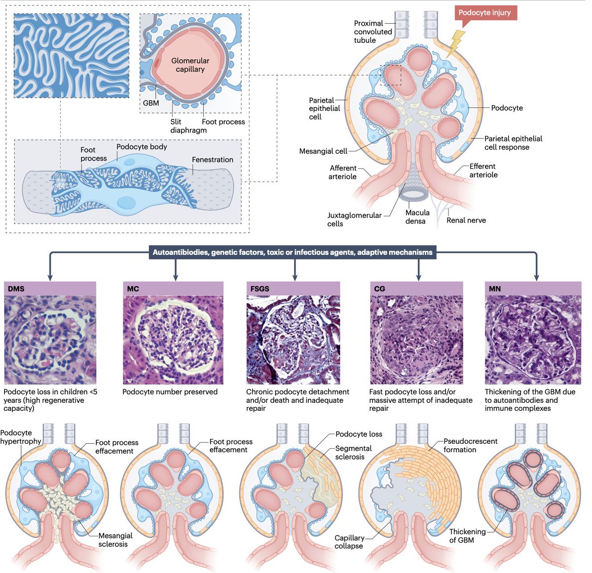 Nephro_Ivan's tweet photo. De las mejores imágenes que resumen los tipos de daño en podocitopatías y su patrón histológico. 
Paras clases de nefro !
😮😮😮🙌🏼🙌🏼🙌🏼
@DiseasePrimers https://t.co/VSuPOJKarr