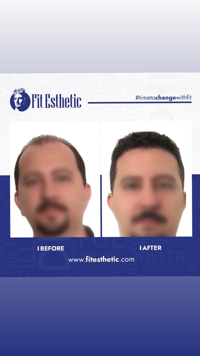 Fit_Esthetic's tweet photo. Saç ekimi, cerrahi bir işlemdir.
Sağlık merkezleri dışında yapılamaz!
#saçekimi
#hairtransplant
#greffedecheveux
#trapiantodicapelli https://t.co/zpCZZtN8gO