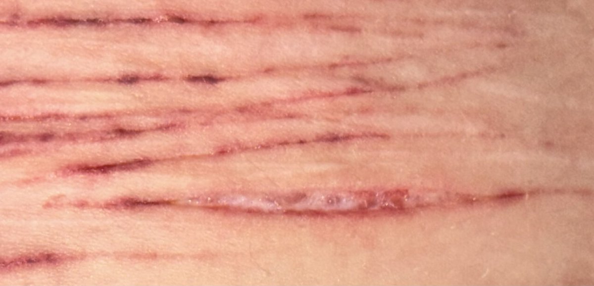 rattlecakes_'s tweet photo. SFX MAKEUP !!
- 
-
-
ALL FAKE. FAKEFAKE FAKE.
-
Apparently i overlapped on some (in the first pic) and it’s all bruised. The one styro i managed is closing up fast. https://t.co/eyx7fUra3W