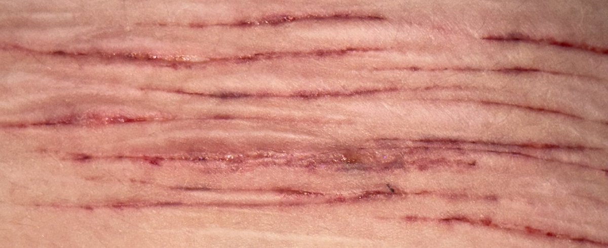 rattlecakes_'s tweet photo. SFX MAKEUP !!
- 
-
-
ALL FAKE. FAKEFAKE FAKE.
-
Apparently i overlapped on some (in the first pic) and it’s all bruised. The one styro i managed is closing up fast. https://t.co/eyx7fUra3W