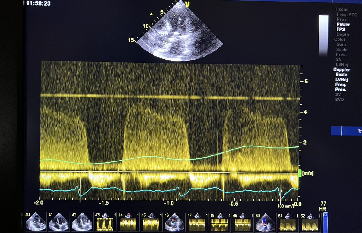 echo_batman's tweet photo. What information is hidden in the AR Doppler signal? https://t.co/N36PlF3m4e