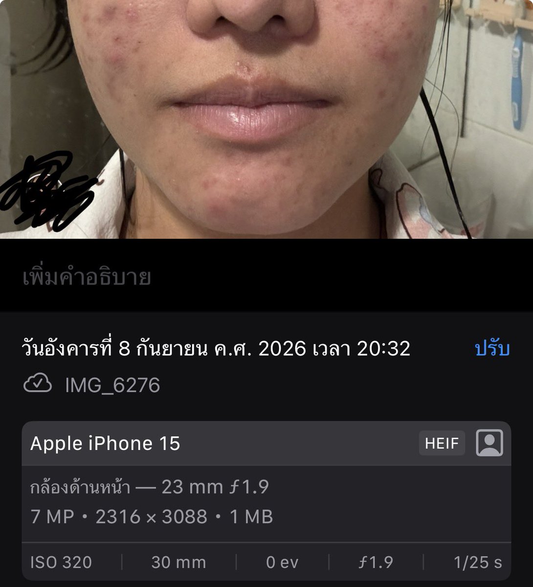 Meilymemeaw's tweet photo. ก๊อกๆ ทุกคนมีใครเป็นสิวเรื้อรังแบบเค้ามั้ย เค้าจะมาบอกต่อสกินแคร์ที่ใช้ตอนนี้ ขอปักให้น้า
1.เบนแซก อันนี้ซื้อจากร้านขายยาใกล้บ้านได้เลยคับราคา ประมาณ100กว่าๆ
2.ลดรอยเค้าใช้ clear nose ขวดม่วง 
3.มอยส์ห้ามขาดเลย
4.กันแดดใช้ของ AQUA 
#shopeeaffiliate https://t.co/6xHlqBwW1J