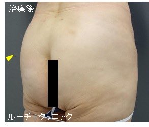 sekaino0852's tweet photo. 男から見ても銭湯とかでたまにこんな尻のジジイとかオッさん見ると少しは運動しろよ汚えなって思うもんな https://t.co/XqCDlvCoBz