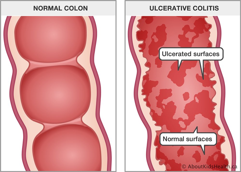 VivaHealthyLife's tweet photo. Ulcerative Colitis: Natural Treatment By Dr. Tsan
Treatment for ulcerative colitis is known for its low success rate. In some cases, treatment for ulcerative colitis requires... Read more: https://t.co/KLsoU5ZVMq #ucl #ulcerativecolitis #stomachache #rectalbleeding #holistic https://t.co/ACOJfo8NIW