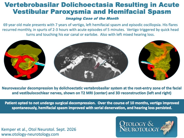 OandNonline's tweet photo. Imaging case of the month: “Vertebrobasilar Dolichoectasia Resulting in Acute Vestibular Paroxysmia and #HemifacialSpasm”. #Neurotology #Vertigo https://t.co/HSoytq4tqb https://t.co/eeHJgRWzRu