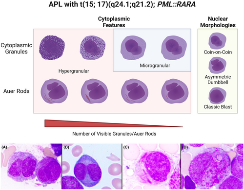 smbenlazar's tweet photo. APL with t(15;17)(q24.1;q21.2); PML::RARA 
>>> Phenotypic clues that predict underlying cytogenetic/genetic abnormalities in myeloid malignancies: A contemporary review - Stone - 2023 - Cytopathology - Wiley Online Library https://t.co/eYR9kSfNAt #AML #leusm https://t.co/mAjLw8mCJM