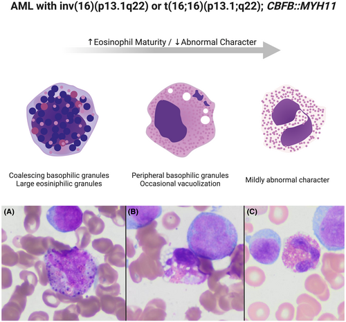 smbenlazar's tweet photo. AML with inv (16)(p13.1;q22) or t(16;16)(p13.1;q22); CBFB::MYH11 #AML #leusm https://t.co/nhTqkJYNdd