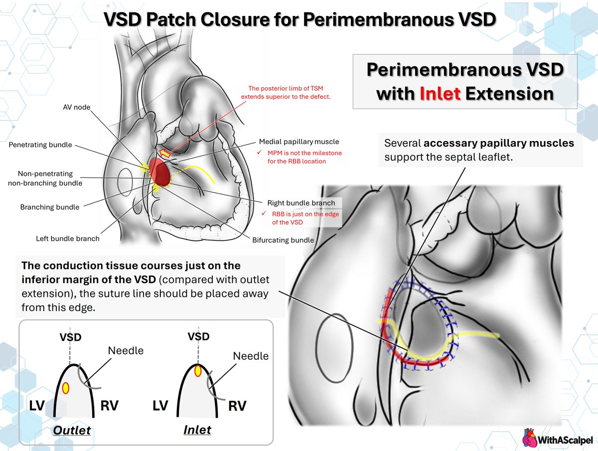 WithAScalpel's tweet photo. VSD Patch Closure for Perimembranous VSD with Inlet Extension🧐

👉In inlet-extended perimembranous VSD, the conduction axis courses along the inferior margin, so sutures should be placed away from this edge.
👉Accessory papillary muscles and septal leaflet attachments can obscure the true rim; medial papillary muscle is not a reliable landmark for the right bundle branch.