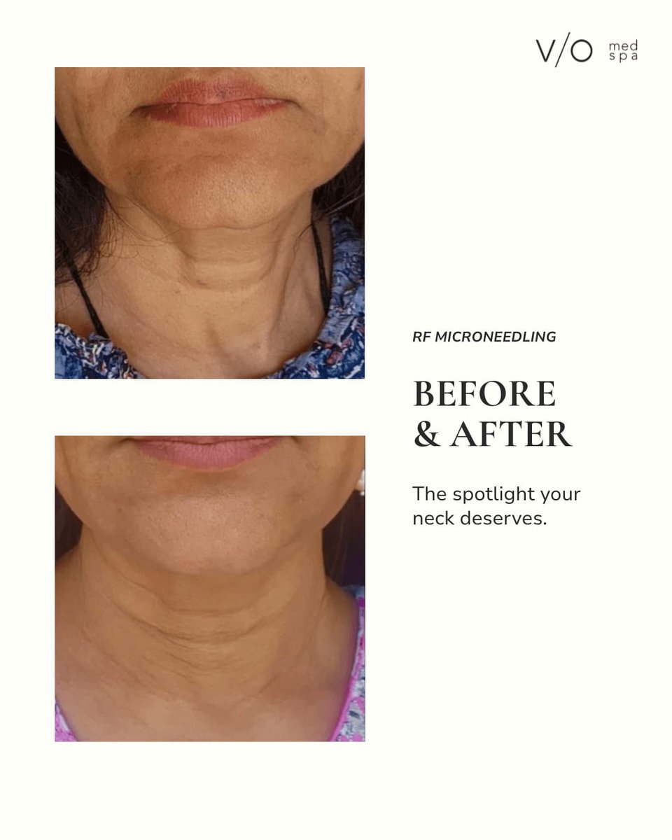 VIOMedSpaFM's tweet photo. Three RF microneedling sessions over twelve weeks.

Her goal: improve the appearance of neck lines, texture and firmness without changing what made her look like herself.

Personalized treatment planning at V/O Med Spa Fort Myers.

https://t.co/pyEwFxh88I

#RFMicroneedling #FortMyersSkincare #VioMedSpaFortMyers