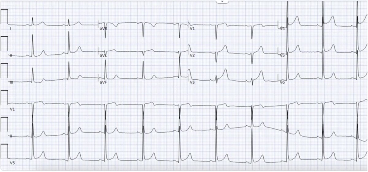 smithECGBlog's tweet photo. 50-year old with chest pain: serial ECG ‘STEMI negative:’ does the patient have Occlusion MI (OMI)?

https://t.co/HSsy7UP9pU

Highlights the stupidity of the NSTEMI guidelines: "NSTEMI" is worthless, and no one follows the "high risk" NSTEMI guidelines.

@ECGcases @PMcardioApp https://t.co/kxOxlueHIs
