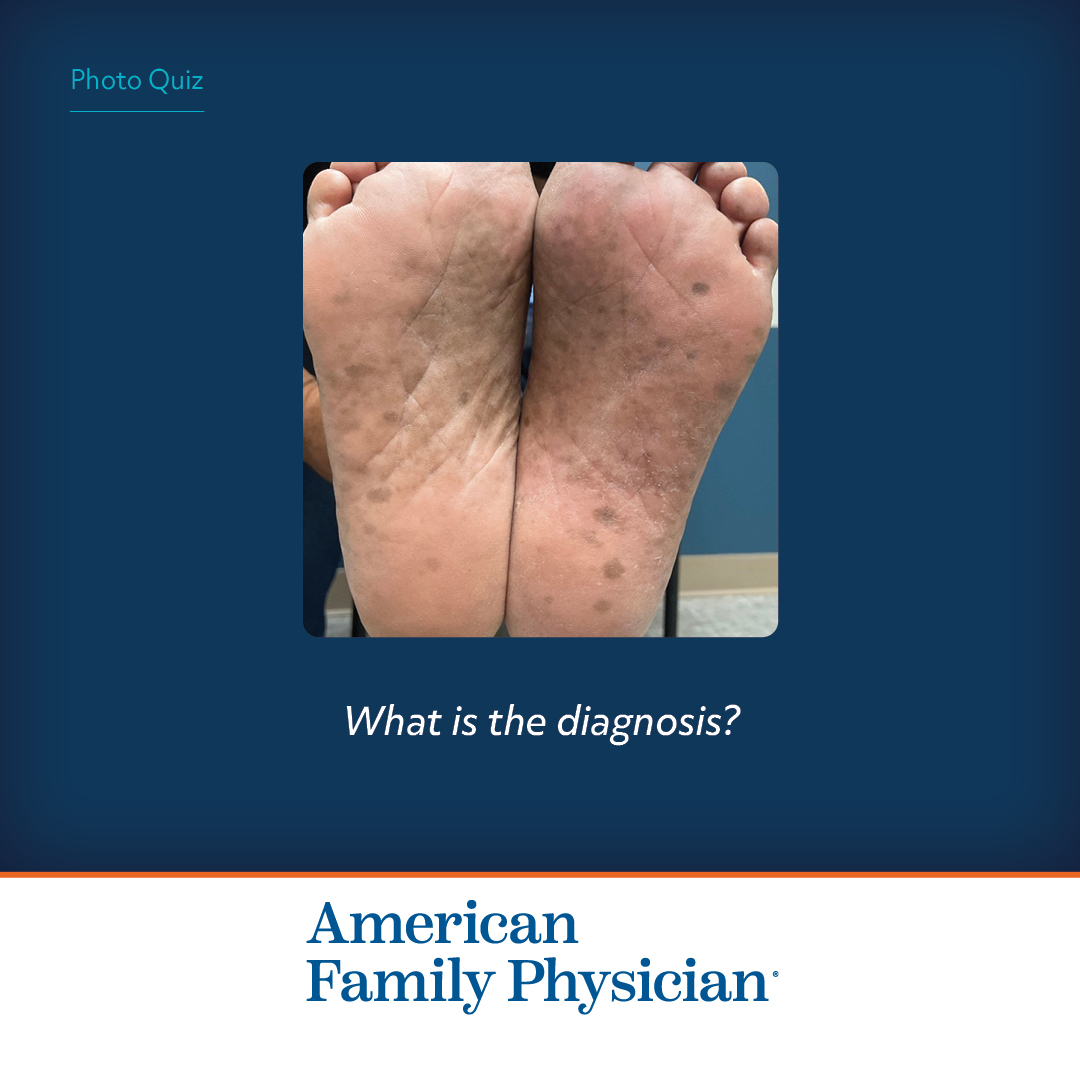 AFPJournal's tweet photo. What is the diagnosis? https://t.co/HW92dkotpp

#AFPJournal #FamilyMedicine https://t.co/QxiuxteuA9