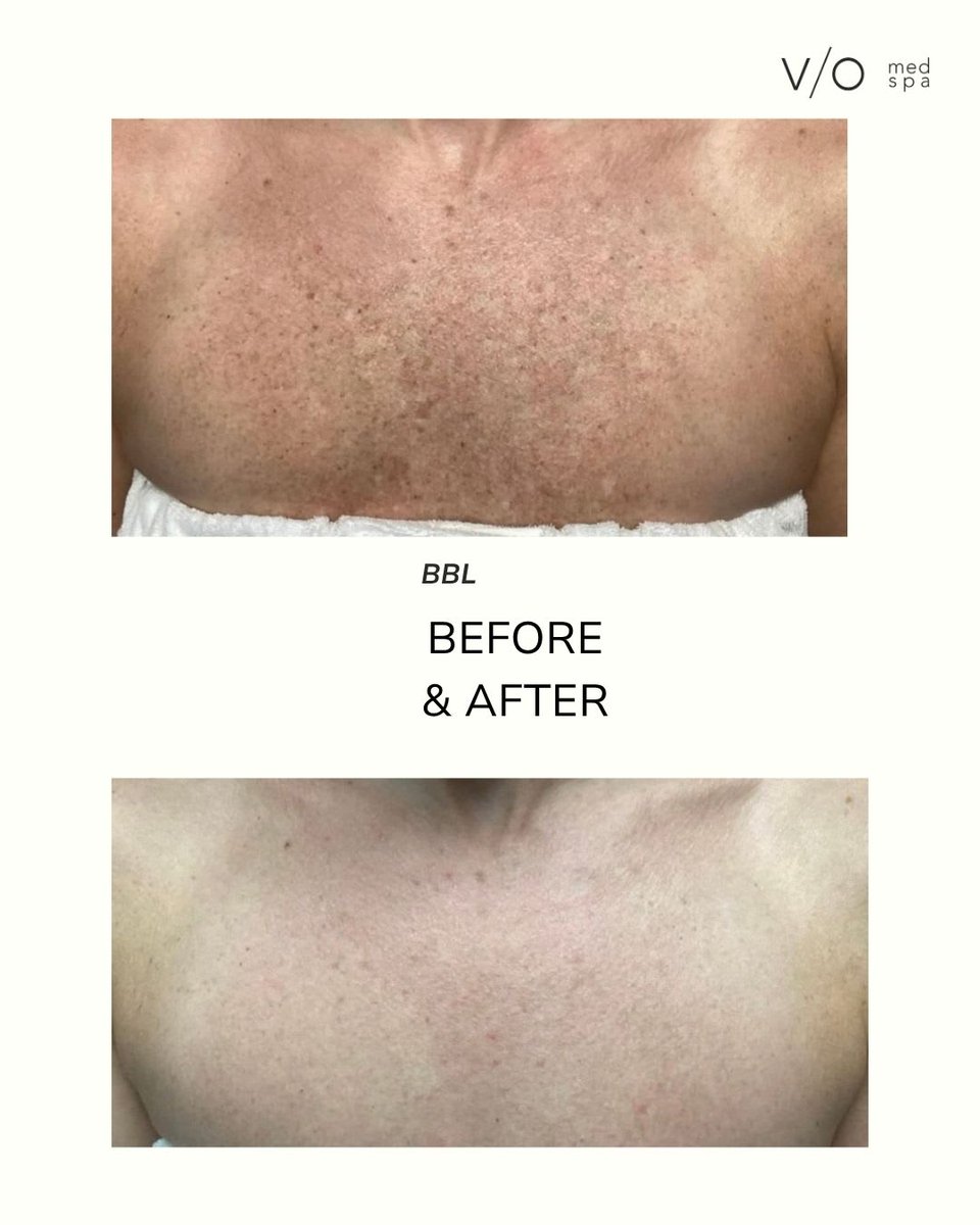 VIOMedSpaFM's tweet photo. The treatment gets the attention. The plan gets the result.

BBL result shared from the wider V/O community, showing visible improvement in the appearance of chest pigmentation.

Individual results vary.

#BBL #FortMyersSkincare #VioMedSpaFortMyers https://t.co/cdaqqnHIeQ