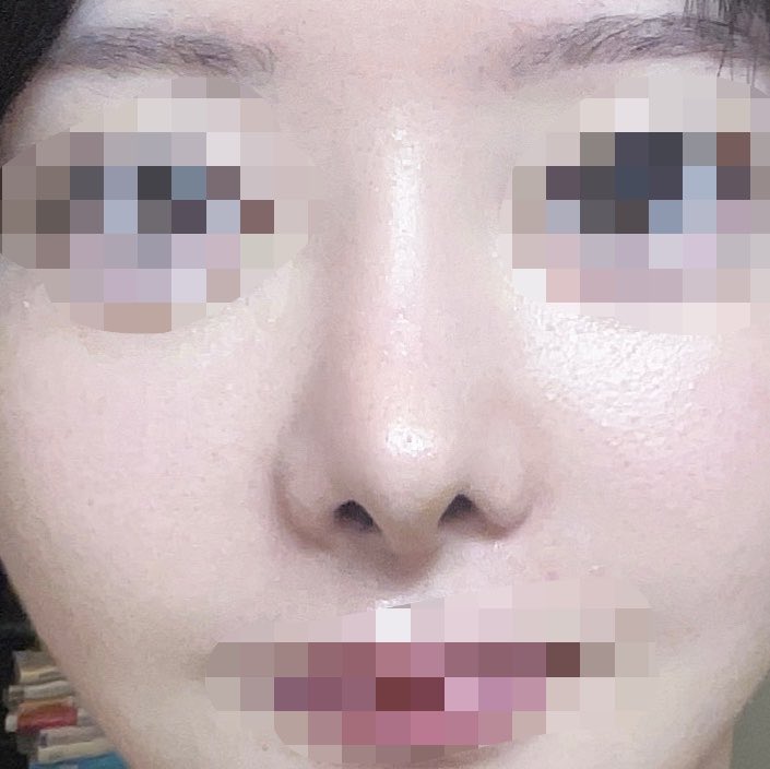 y_seikeiol's tweet photo. 鼻DT7ヶ月経って、
正面がかなりスッキリしたので比較。

鼻孔縁下降はいつかしてもいいかなって思うけど、鼻デカくなるって見かけるから悩み中😖

←DT2週間
DT7ヶ月→ https://t.co/Bur61oOJLM