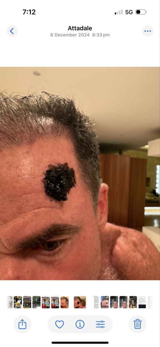 catchi888's tweet photo. @stephanieseneff I have used black salve successfully for the last twenty years, here is a large infiltrative bcc I removed the last pic is a month later https://t.co/puQfuBpBD5