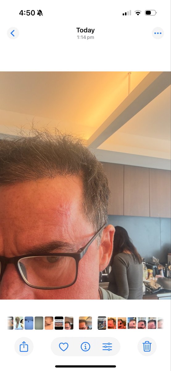 catchi888's tweet photo. @stephanieseneff I have used black salve successfully for the last twenty years, here is a large infiltrative bcc I removed the last pic is a month later https://t.co/puQfuBpBD5