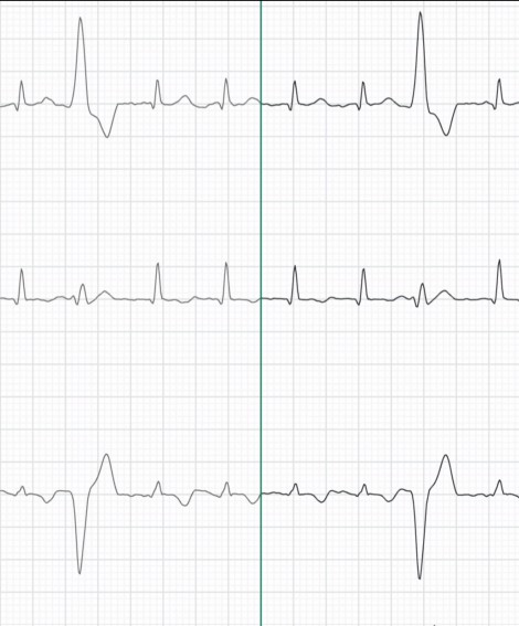 sirplustwo's tweet photo. This screenshot of this ECG clip from Lady A is one of our hottest yet, check out the 20+ skips!  

https://t.co/LSjOv6ehZ9

#cardiophile #cardiophilia #cardiofilia #heartbeat #heartbeatkink #heartfreak #ECG #irregularheartbeat #skippy #skippybeats #PVC https://t.co/V3A6PGjeY1