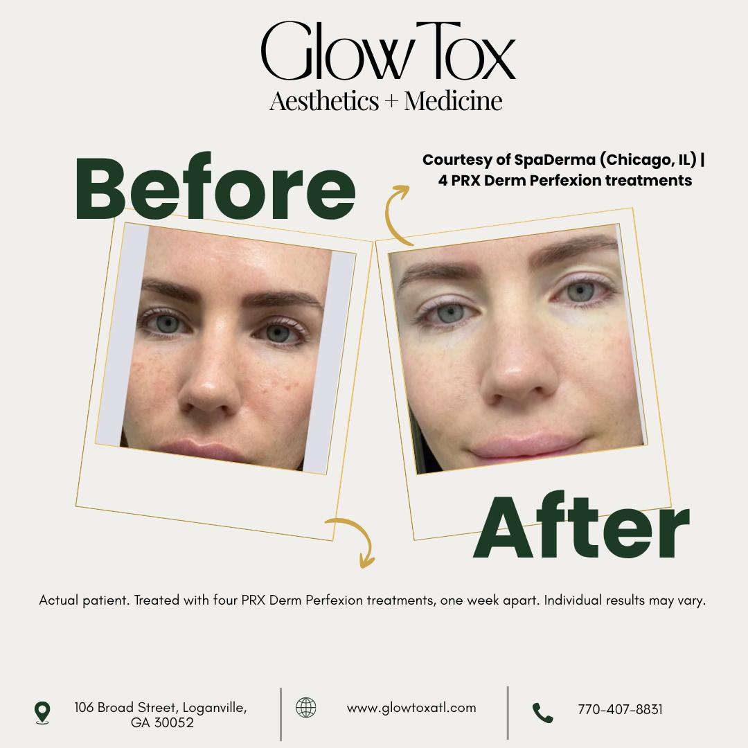 TanekaMyrelc's tweet photo. The difference is in the details. Swipe to see real PRX results. These before-and-after photos show how PRX Derm Perfexion may support a personalized plan to improve texture, tone, radiance, and visible signs of aging. Results and treatment plans https://t.co/QCYXRJ43y7