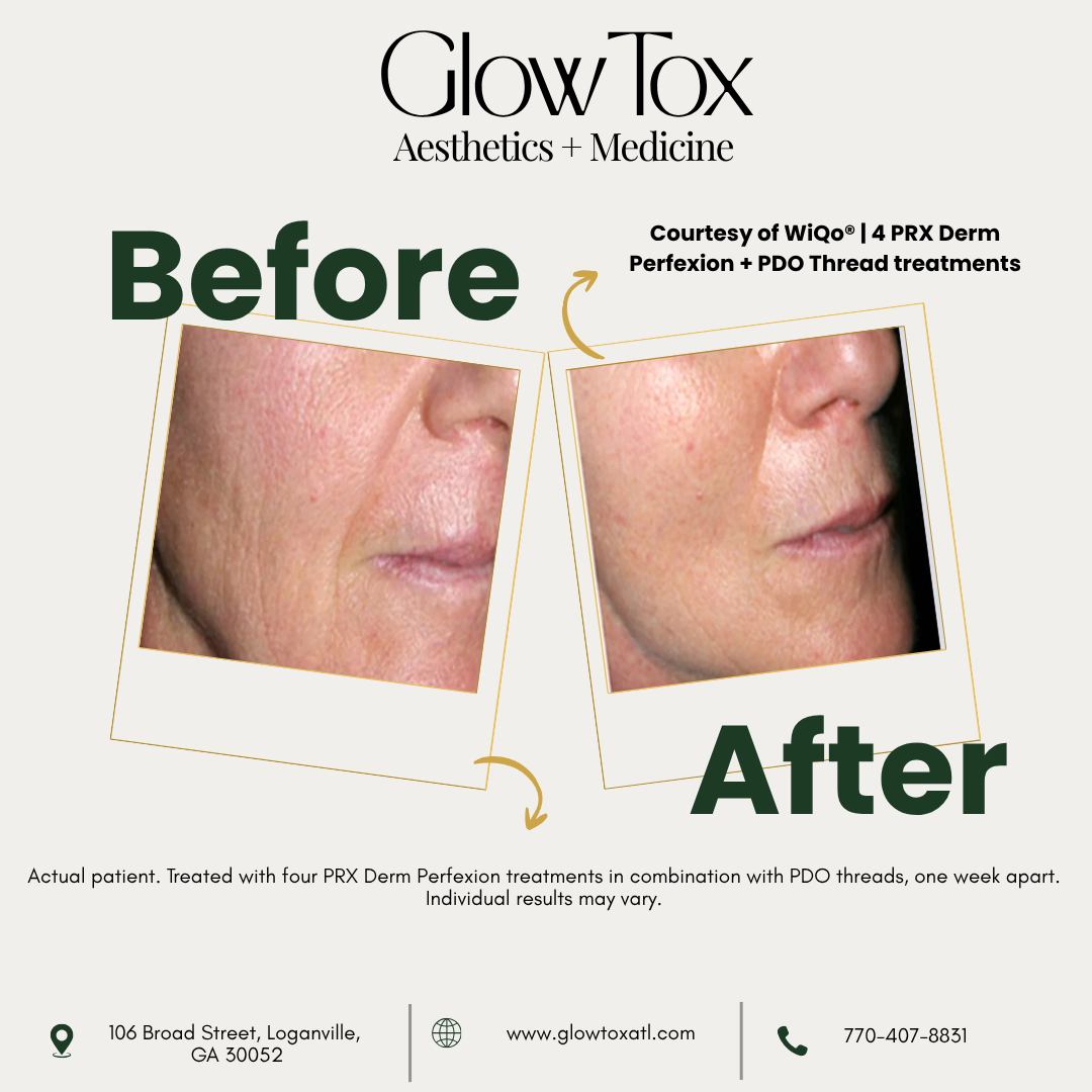TanekaMyrelc's tweet photo. The difference is in the details. Swipe to see real PRX results. These before-and-after photos show how PRX Derm Perfexion may support a personalized plan to improve texture, tone, radiance, and visible signs of aging. Results and treatment plans https://t.co/QCYXRJ43y7