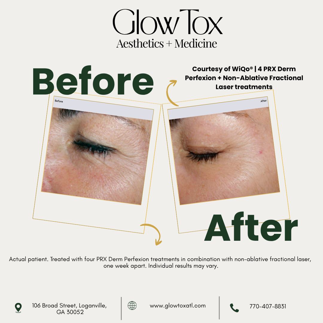 TanekaMyrelc's tweet photo. The difference is in the details. Swipe to see real PRX results. These before-and-after photos show how PRX Derm Perfexion may support a personalized plan to improve texture, tone, radiance, and visible signs of aging. Results and treatment plans https://t.co/QCYXRJ43y7