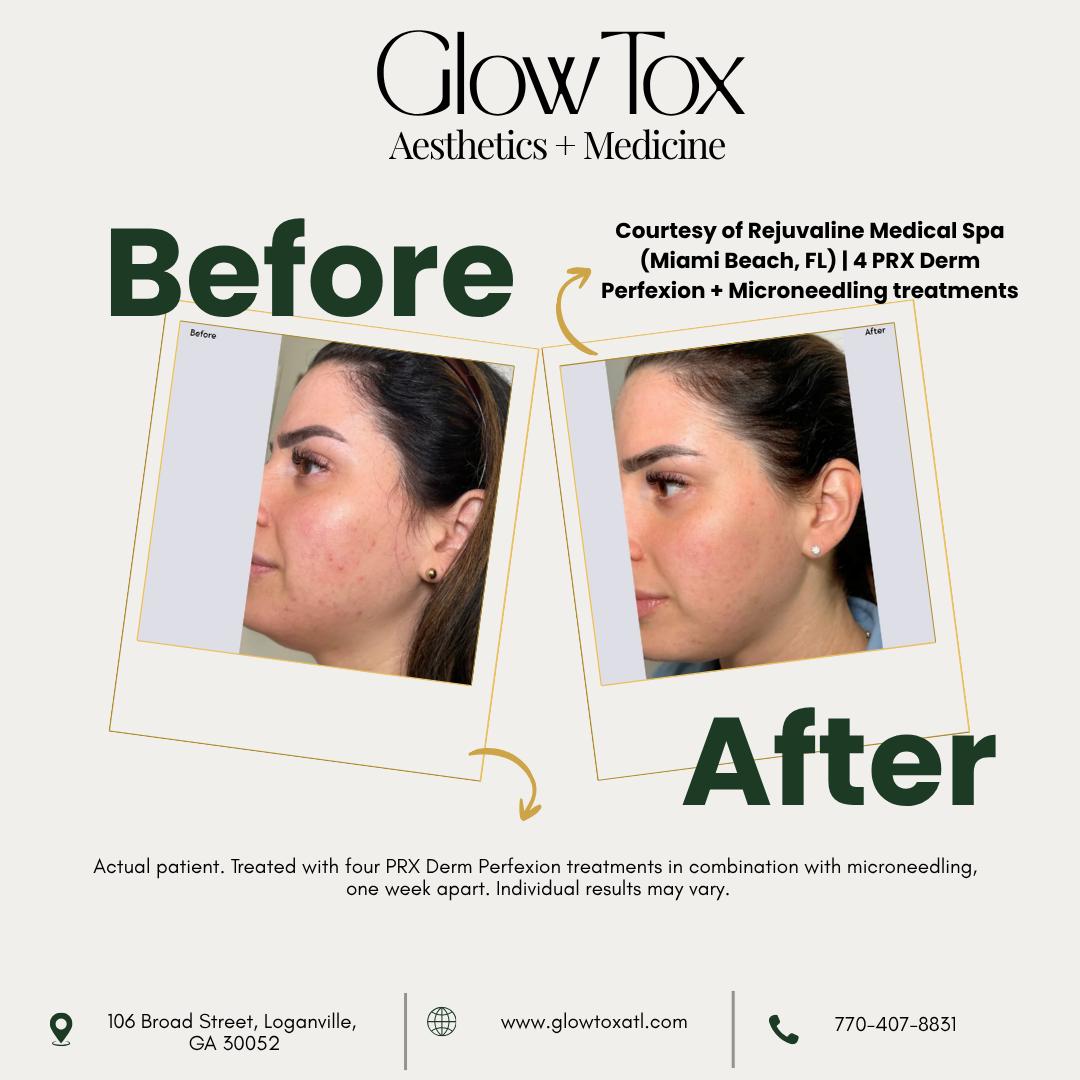 TanekaMyrelc's tweet photo. The difference is in the details. Swipe to see real PRX results. These before-and-after photos show how PRX Derm Perfexion may support a personalized plan to improve texture, tone, radiance, and visible signs of aging. Results and treatment plans https://t.co/QCYXRJ43y7