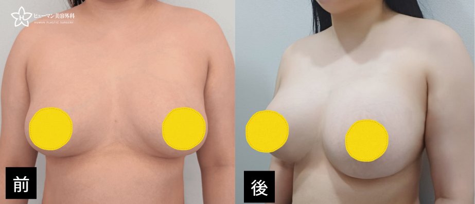 humanpsjp's tweet photo. 【ヒューマン美容外科｜豊胸症例】

豊胸再手術｜キム・グクヒョン代表院長

モティバ300ccからメンター・ブースト530ccへ豊胸再手術✨
両側のサイズ調整に加え、乳房下縁切開・傷跡除去・被膜形成術・被膜除去を行いました。

📩 LINE：humansjp

📷 症例の詳細はこちら
https://t.co/6HerKdA08r https://t.co/vSMlDQb1XX