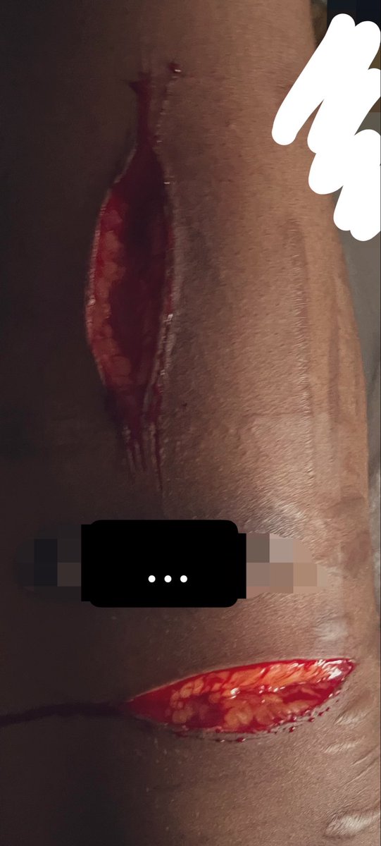 caeerexi's tweet photo. sh tw!!! deep beans from early this year methinks 

missing it bad

#selfharm #shtwt #shedtwt #beanstwt #beanshtwt #beanspo #cutspo https://t.co/caoCwBUzpN