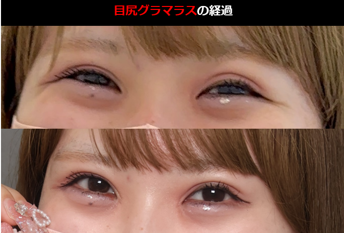 dr_egoh's tweet photo. @anocchi33 下瞼を触ると不自然になるケースがあるのは事実だと思います。

特に、笑ったときなど動きのある場面で違和感が出やすい印象です。

静止画では問題なく見えても、表情がつくと崩れてしまうケースもあります。

参考までに、笑った状態でも自然な症例を置いておきます。 https://t.co/mhRTYW1dBy