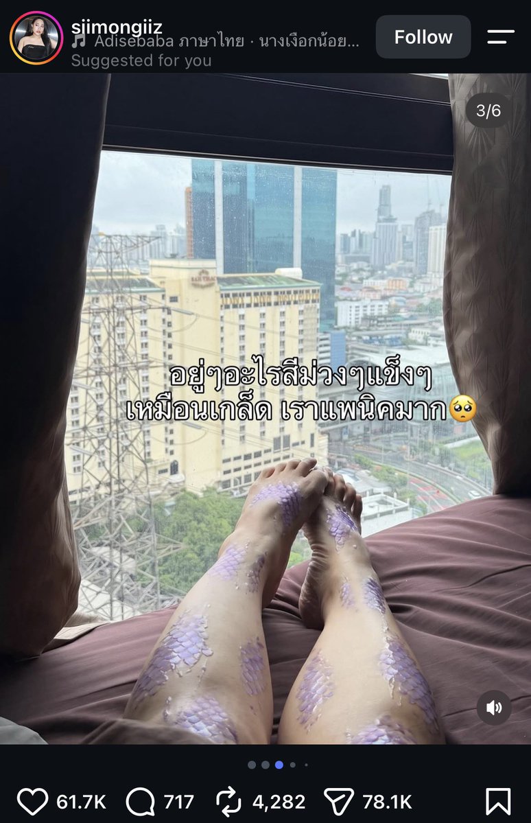 diarytotravel's tweet photo. เมื่อกี้บังเอิญไถไอจี เจอโพสต์นี้แล้วสงสารมาก 
เดินลุยน้ำ 3 วันตุ่มแดงขึ้นเพียบเลย
ใครที่เดินเท้าเปล่าไม่มีอุปกรณ์ป้องกันระวังเป็นแบบพี่เค้าของไอจีนะคะ ขนลุกมาก 😱😱 https://t.co/lB9yaZRnzL