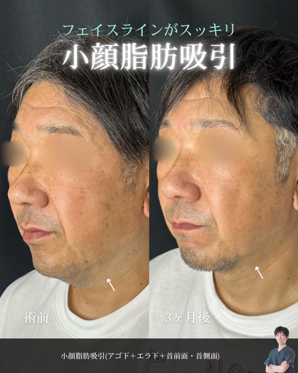 lula_sendai's tweet photo. こんにちは！
ルラ美容クリニック仙台院です🏥

小顔脂肪吸引���すっきりアゴ下に✨
二重アゴが気になる方、フェイスラインを綺麗にしたい方におすすめです🧑‍⚕️

カウンセリング無料です！お気軽にご相談ください🤍

#ルラ美容クリニック #ルラ美容クリニック仙台院 #整形 #小顔 #脂肪吸引 https://t.co/QVikQKL1n2