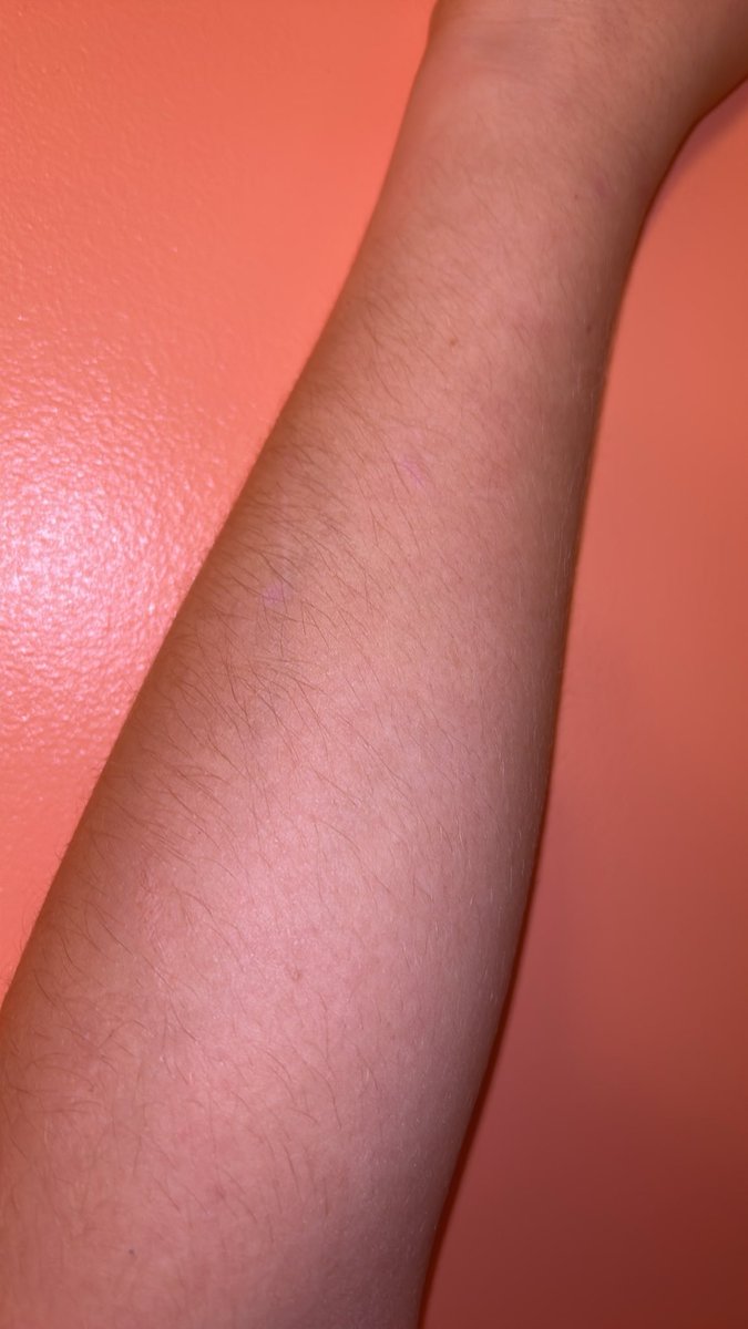 Squippppp's tweet photo. Are my scars noticeable I can’t tell 🤔🤔🤔 #viraltweetlol https://t.co/DclHatXb50