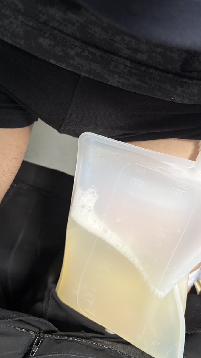 catheter_dp's tweet photo. 今日から留置で1ヶ月保つかなぁ、

1時間くらいでこれって汗かかないとすごいなぁ、 https://t.co/KZGc3iceDr
