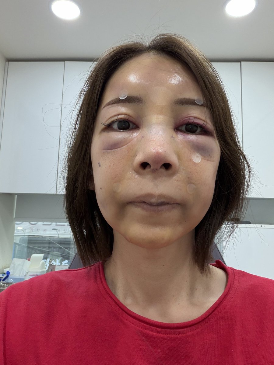 sarapi32063142's tweet photo. 絶望した日ww
私腫れ体質で術後２日目が恐ろしく腫れました！すぐに病院に連絡し、先生も丁寧にみてくださり安心できました！１枚目２枚目は、めっちゃ腫れた時の写真。３枚目４枚目は3週間後😁
焦らない、絶対綺麗になると信じる事🥰泣かない☺️
#鼻フル#整形#韓国#美容#ダウンタイム#綺麗になりたい https://t.co/cyovkHttA7