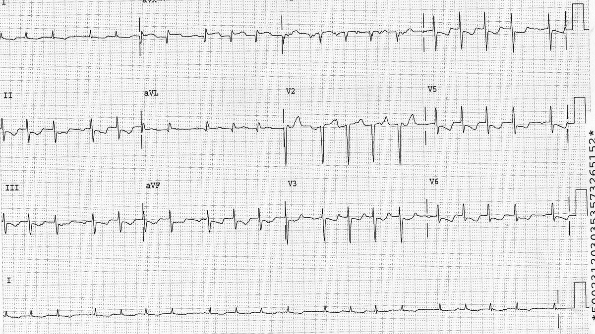 PPodrid's tweet photo. Patient with known palpitations. Pulse is regular with occasional pauses. What does the ecg show? #PodridECG #ECG #meded #cardiotwitter https://t.co/UWnmuaLKCe