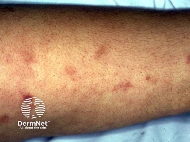 SkinofColorcomm's tweet photo. Monday mystery!
A patient presents with painful subcutaneous nodules, livedo reticularis, and ulcers on the lower legs without systemic involvement. What’s the diagnosis?
A. Cutaneous polyarteritis nodosa
B. Erythema nodosum
C. Leukocytoclastic vasculitis
D. Pyoderma gangrenosum https://t.co/X7et3QemUT