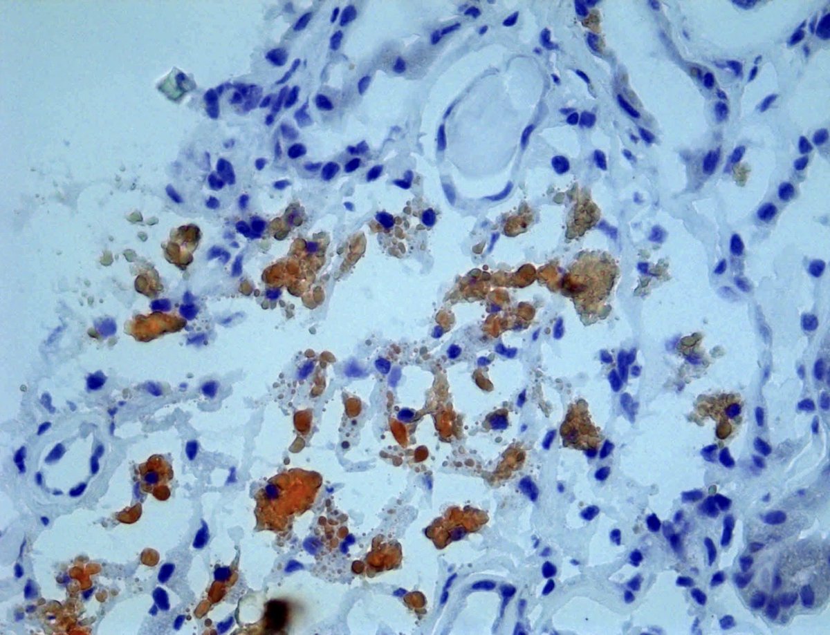 DavidWanderley's tweet photo. @grace_choung Here in our laboratory, we’ve seen the same changes in two patients who were also receiving pegcetacoplan. We performed Oil Red O staining and found lipid positivity. We had started writing up our cases for publication, but hadn’t finished the manuscript yet. https://t.co/uPwBgv5U4S