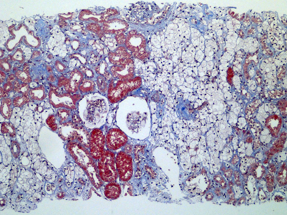 DavidWanderley's tweet photo. @grace_choung Here in our laboratory, we’ve seen the same changes in two patients who were also receiving pegcetacoplan. We performed Oil Red O staining and found lipid positivity. We had started writing up our cases for publication, but hadn’t finished the manuscript yet. https://t.co/uPwBgv5U4S