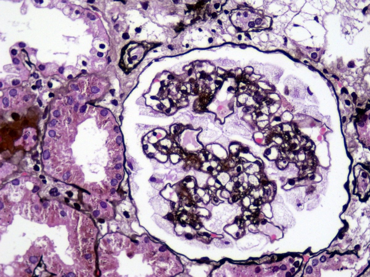 DavidWanderley's tweet photo. @grace_choung Here in our laboratory, we’ve seen the same changes in two patients who were also receiving pegcetacoplan. We performed Oil Red O staining and found lipid positivity. We had started writing up our cases for publication, but hadn’t finished the manuscript yet. https://t.co/uPwBgv5U4S