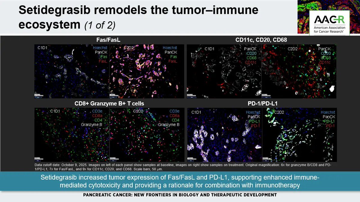 CentralParkWMD's tweet photo. What happens when you actually DEGRADE KRAS G12D in pancreatic cancer?

At #AACRPanc26 we shared translational analyses of setidegrasib, the first-generation KRAS G12D degrader. @AstellasUS

15 paired tumor biopsies let us watch the biology change in patients:

Successful deep KRAS protein degradation.✏️
→↓ MAPK signaling
→ tumor-immune remodeling including Fas/FasL, Granzyme B+ CD8 T cells & PD-L1
→ distinct primary + acquired resistance biology!
→ rational mFOLFIRINOX and maybe immune combinations?

Parallel virtual patient and patient-derived organoids experiment from @orakldotbio predicting the human clinical trial outcomes independently. 

What should we do next?
Patient → biopsies 💉→ biology 🧫→ model → combination → back to patient 

Huge thanks to our coauthors, Shilpa Kadam @anup_kasi @MacarullaTeresa and research teams and above all the courageous patients who made this work possible.

#KRAS #KRASG12D #PDAC #PancreaticCancer #TranslationalResearch #GRIT #sPARKlab 
@MSK_DeptOfMed @MSKCancerCenter @CpcrMsk 
@oncodaily @OncoDailyGI @OncBrothers @PanCAN @lustgartenfdn @Pankind_Aus @NatPancFdn @EileenMOReilly
