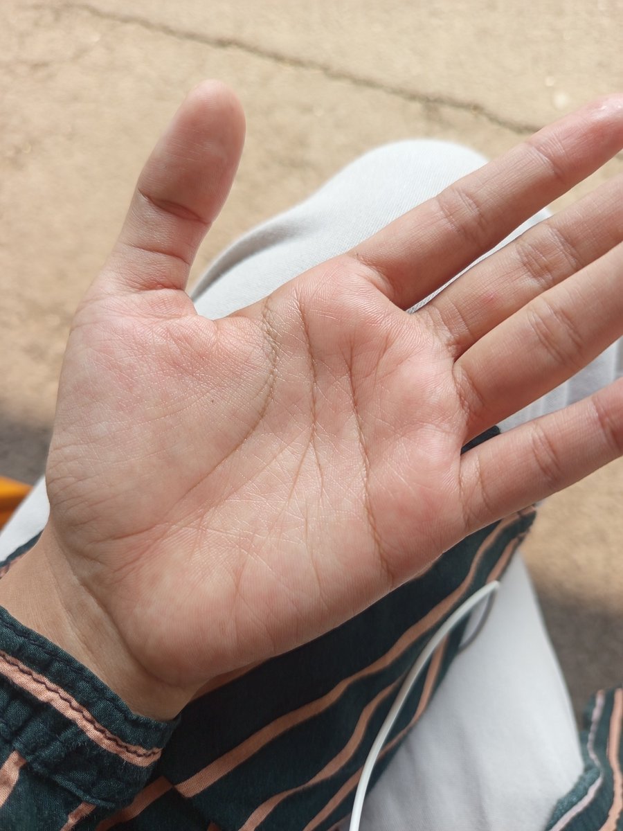 pheipheii's tweet photo. benci banget nih sama hiperhidrosis, astaghfirullahalazim sangat menggangu kenyamanan daily guee 😢😢 https://t.co/gDN96yJ7AB