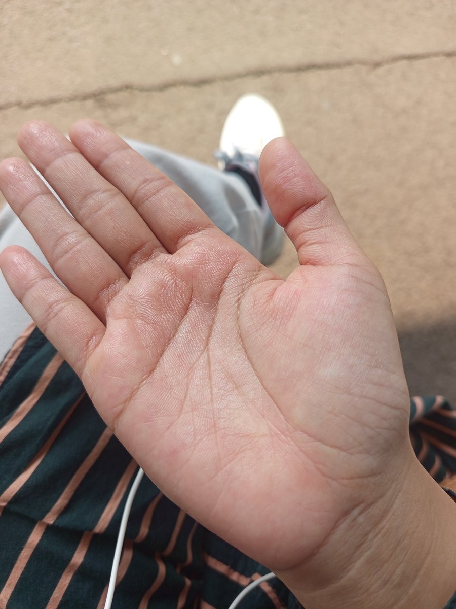 pheipheii's tweet photo. benci banget nih sama hiperhidrosis, astaghfirullahalazim sangat menggangu kenyamanan daily guee 😢😢 https://t.co/gDN96yJ7AB