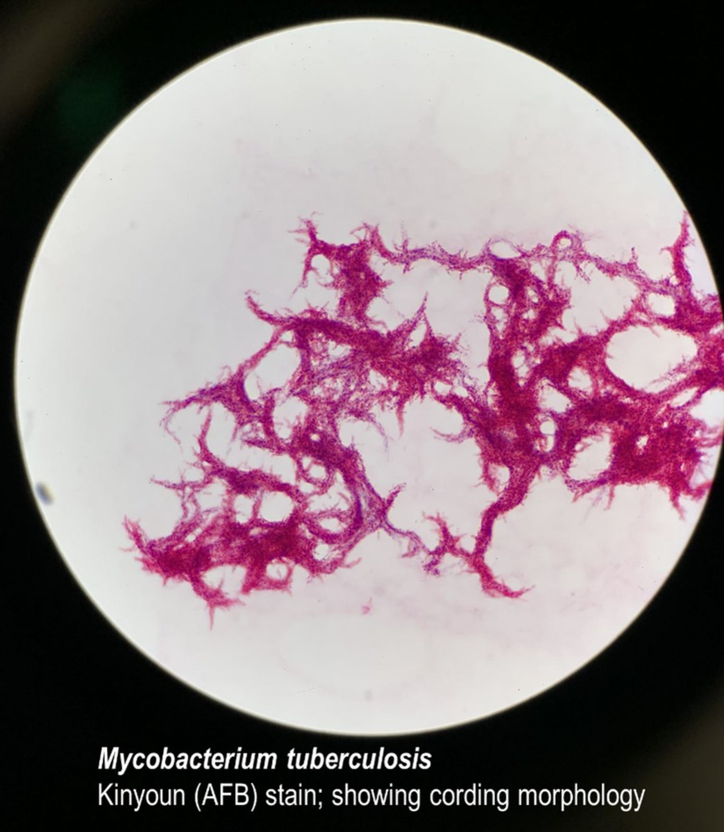 MicrobioUpdates's tweet photo. The classic "serpentine cording" of Mycobacterium tuberculosis isn't just an aesthetic feature under the microscope—it's a masterclass in bacterial pathogenesis driven by Cord Factor (Trehalose-6,6'-dimycolate). 🧵👇 #Microbiology #InfectiousDiseases https://t.co/voZ2CMeb5S